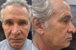 Nelson Freitas faz harmonização facial